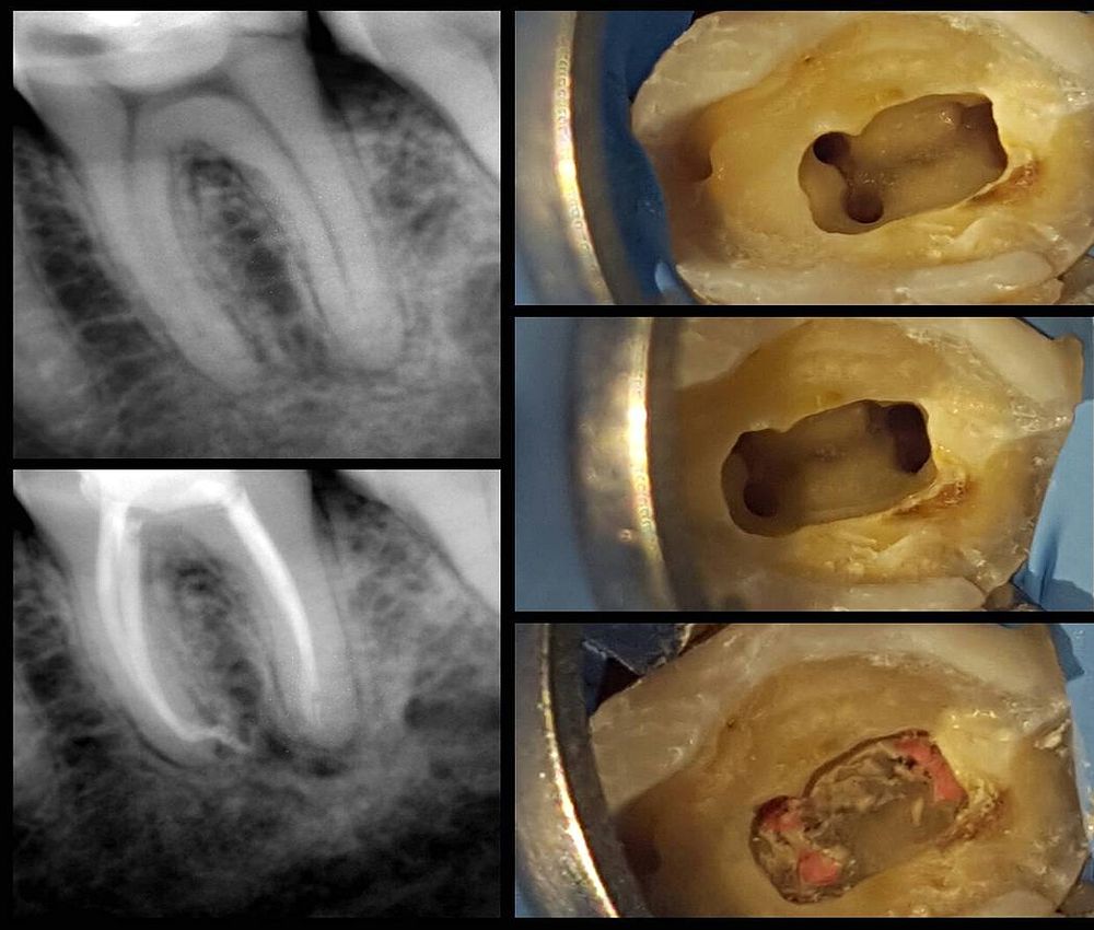 ENDODONCIA y complicaciones tras una endodoncia