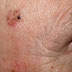Kératose actinique traitement : tâches cutanées rouge...