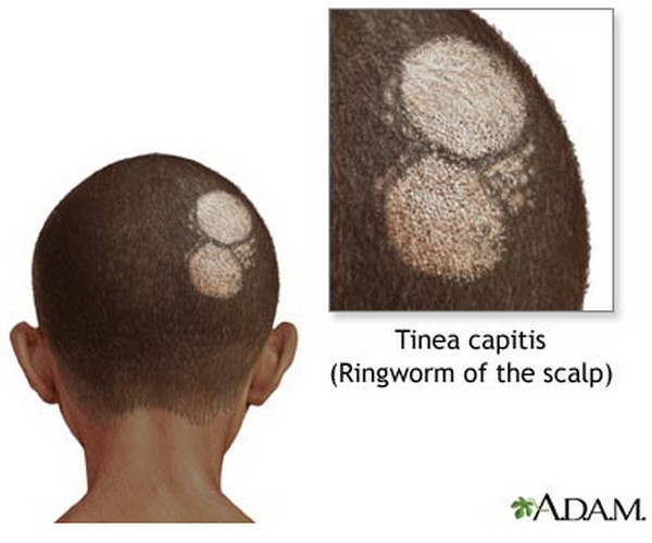 Itchy Scalp - Symptoms, Causes, Treatment and Home Remedies