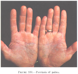 Pustulosa palmoplantar psoriasis (Barber)