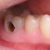 Triệu chứng và cách điều trị sâu răng