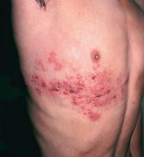 obat penyakit herpes labialis obat penyakit herpes labialis