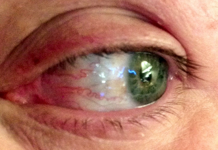 Genes That Don't Fit! If You Have Ehlers Danlos Syndrome You Will