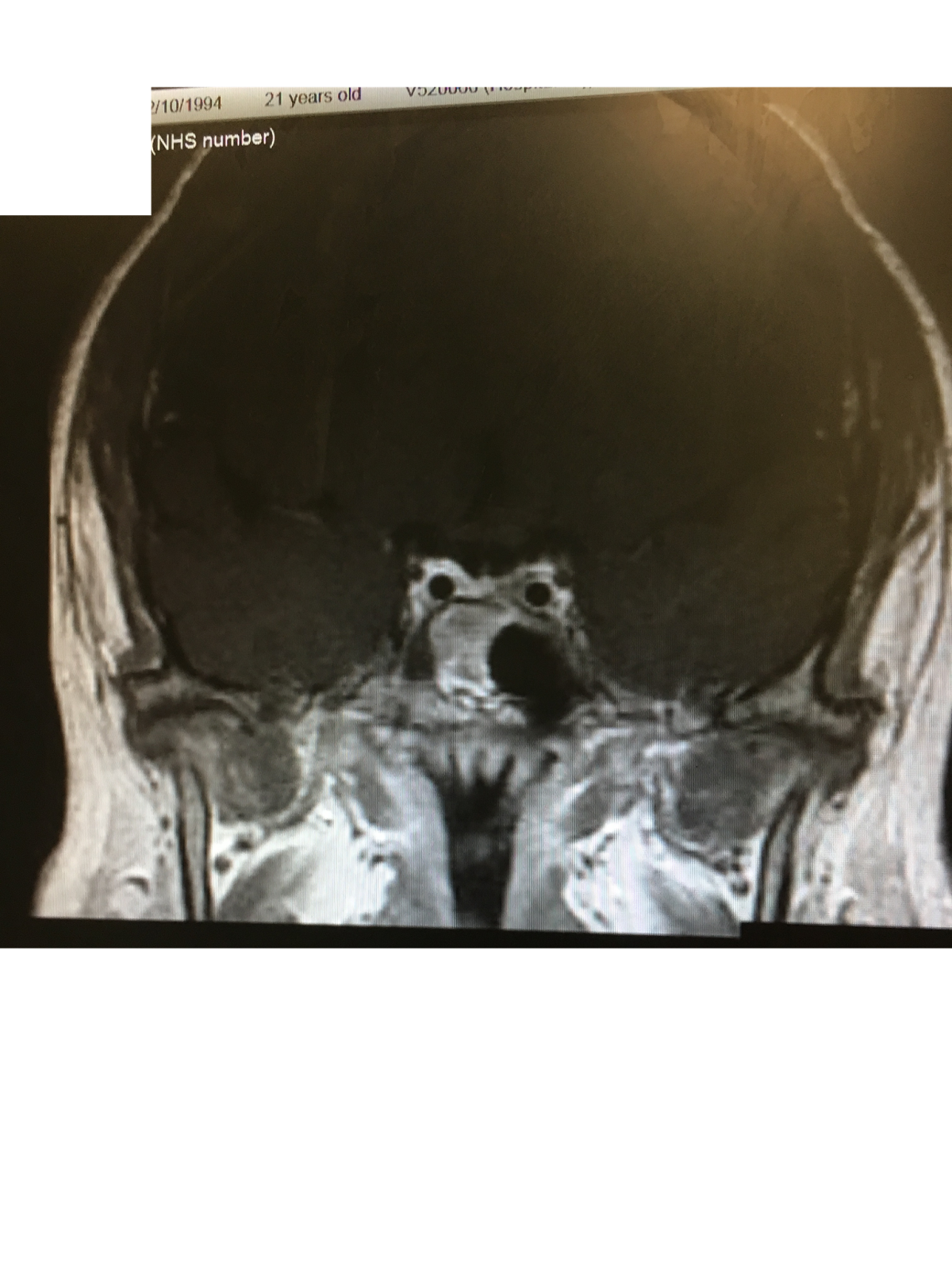 Fixing The Fat Girl's Future My Journey with Cushing's Disease MRI