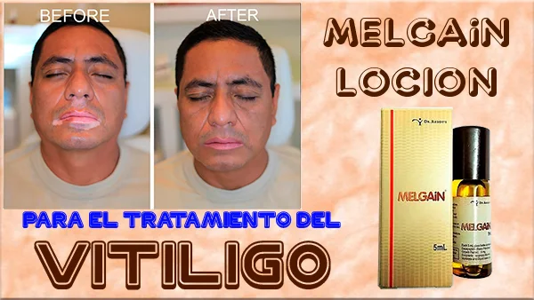 Loción Melgain Para el tratamiento del Vitíligo.