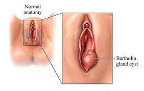Cara mengatasi benjolan di vagina Cara mengatasi benjolan di vagina