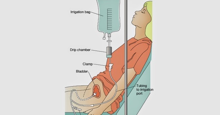 bladder irrigation ppt nursing path bladder irrigation