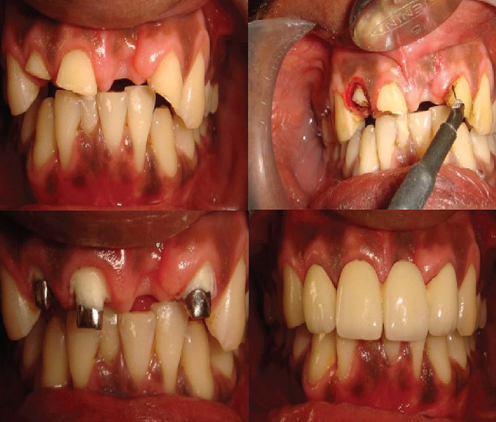 ELECTROSURGERY in aesthetic and restorative dentistry A literature
