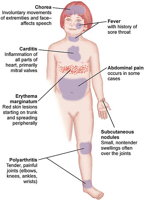 Manifestations of rheumatic fever