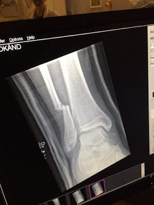 Dave Grohl - broken leg