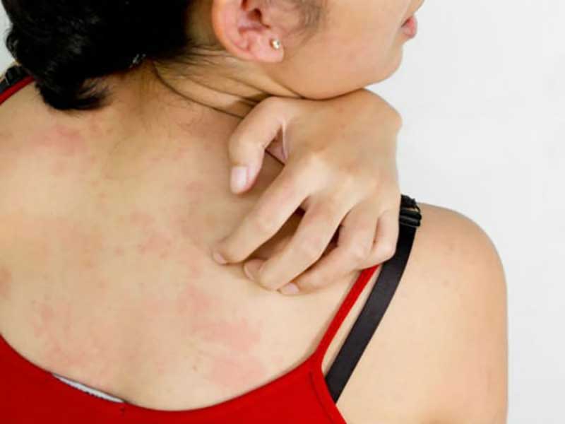 How To Treat Scabies Using Tea Tree Oil? Dr Farrah MD