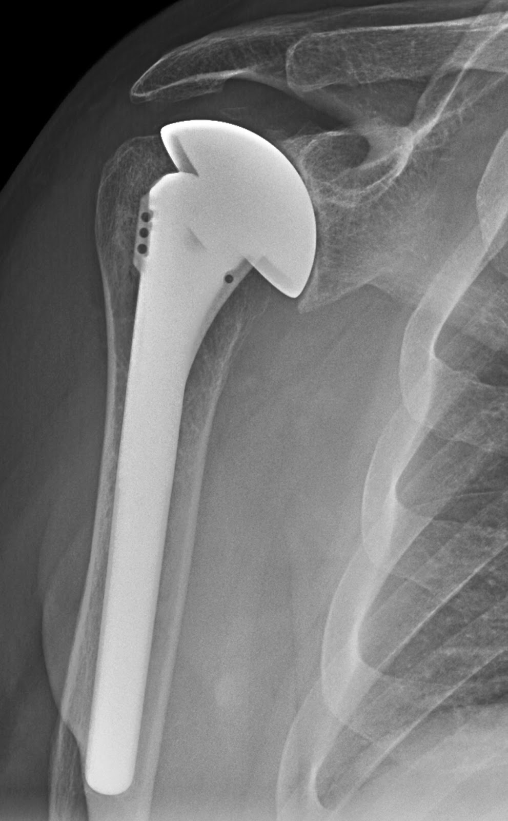 UW Shoulder and Elbow Academy How important is the humeral headshaft