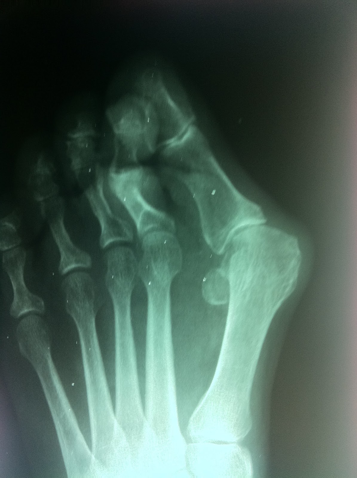 Podiatry Shoe Review Your Feet On XRay Barefoot vs. PointyToe High