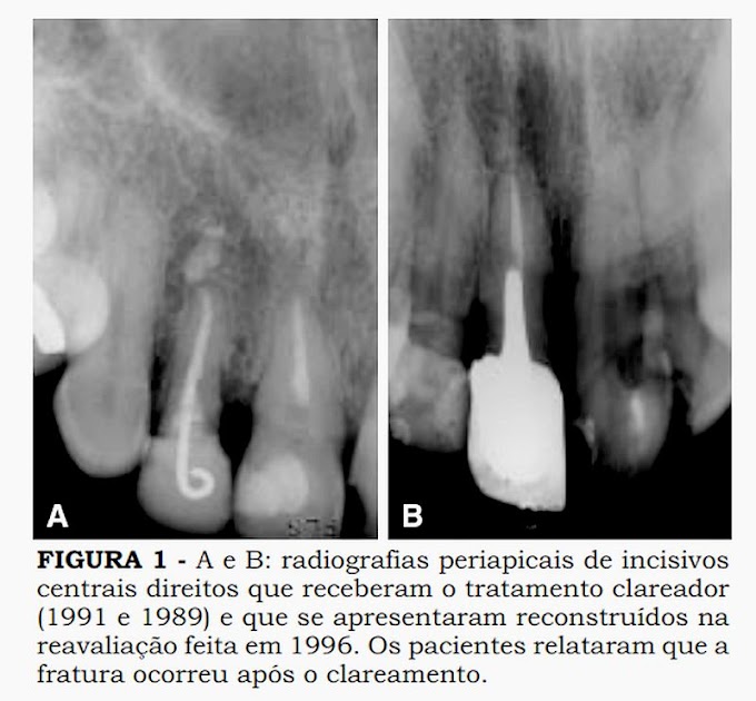 PDF: Avaliação clínica de reabsorção radicular externa em dentes desvitalizados submetidos ao clareamento
