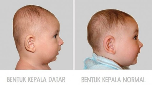 Bunda, Perhatikan Bentuk Kepala Bayi Anda. Hati-hati Jika Bentuk Kepalanya DATAR