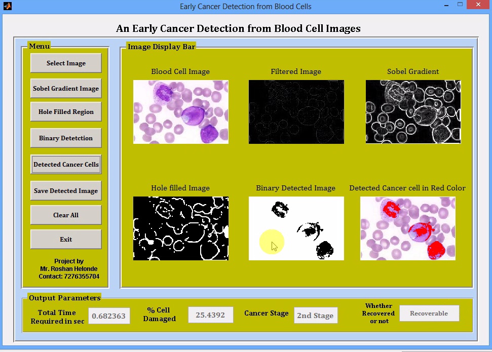 Leukemia (Blood) Cancer Detection Using Image Processing Matlab Project ...