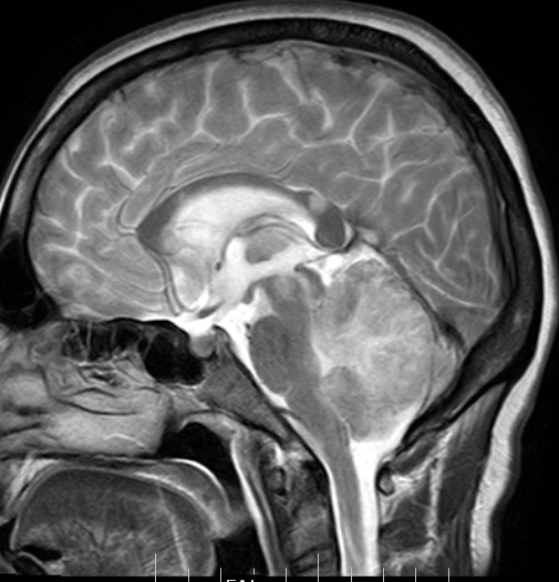 HIV EncephalopathyMRI Sumer's Radiology Blog