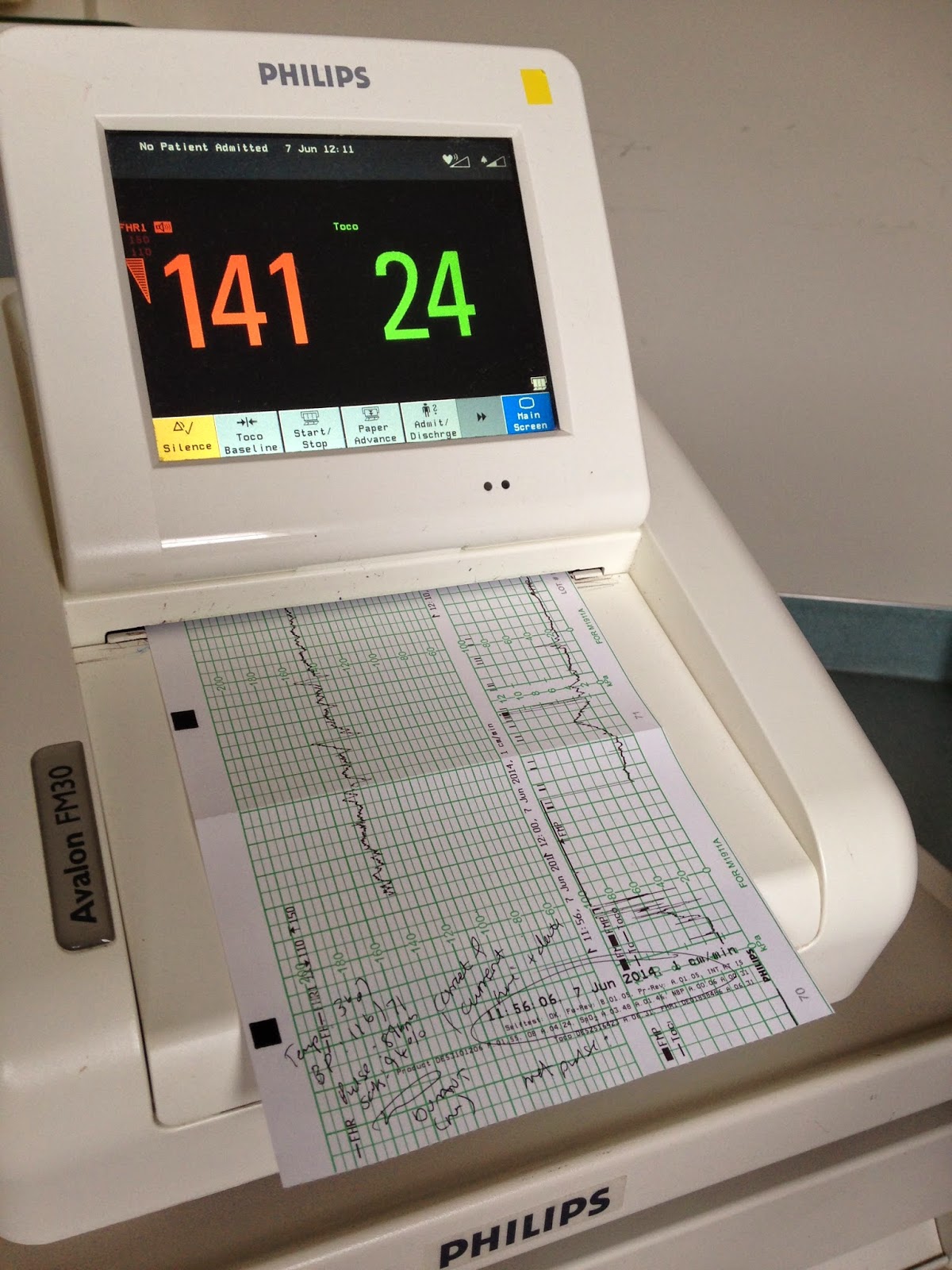Kaitake 35w2d CTG monitoring for suspected placental failure