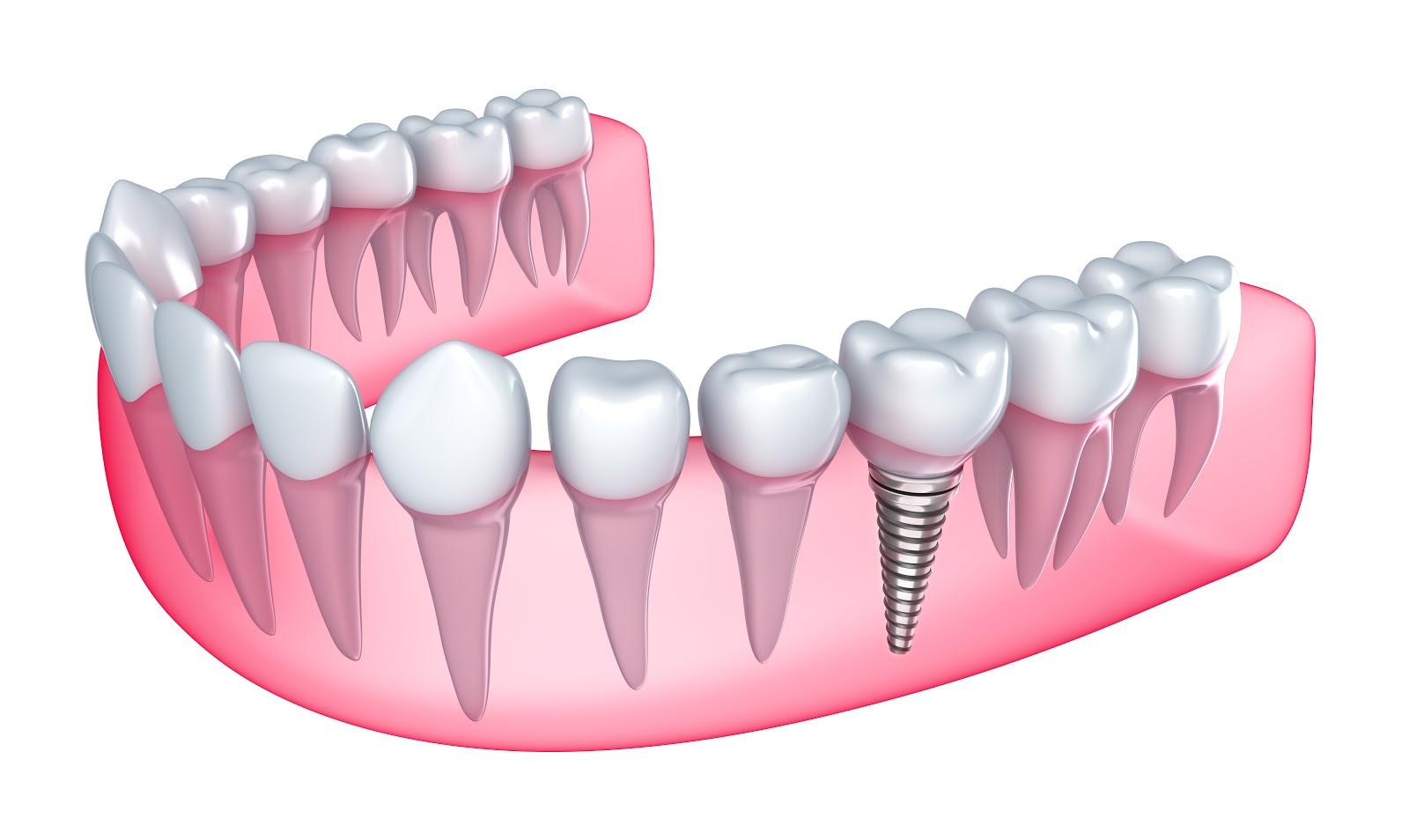 Paducah Dental Care Missing Teeth? Why Dental Implants Should Be Your