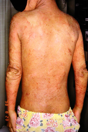 Topical steroid addiction in atopic dermatitis