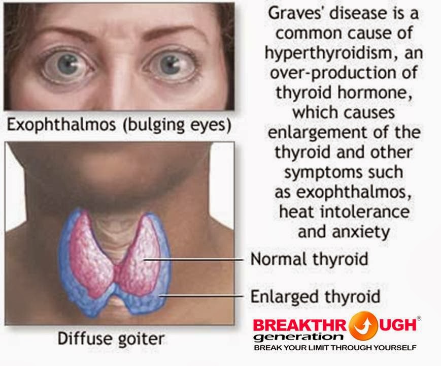 1ST STEP in UNDERSTANDING the BODY STRUMA HIPERTIROID BASEDOW