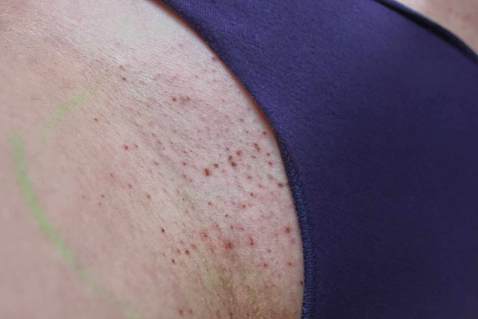 LASEROWA DEPILACJA BIKINI Magda Beauty