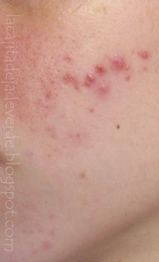 Acne Rosacea Natural Treatment Home Remedies Acne Rosacea Natural Treatment Home Remedies