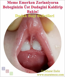 The two problems that can be seen in the lip tie due to the breastfeeding problem are the gap between the upper teeth (diastema) and early tooth decay - How does the upper lip mount facilitate tooth decay? - How can the upper lip tie casue the gap between the teeth (diastema)? - Separation of teeth in patiens with lip tie that causing pitting in the gingiva line - Lip tie release surgery is not always prevent to diastema! - Maxillary Midline Diastema - Upper Lip Ties (ULT)