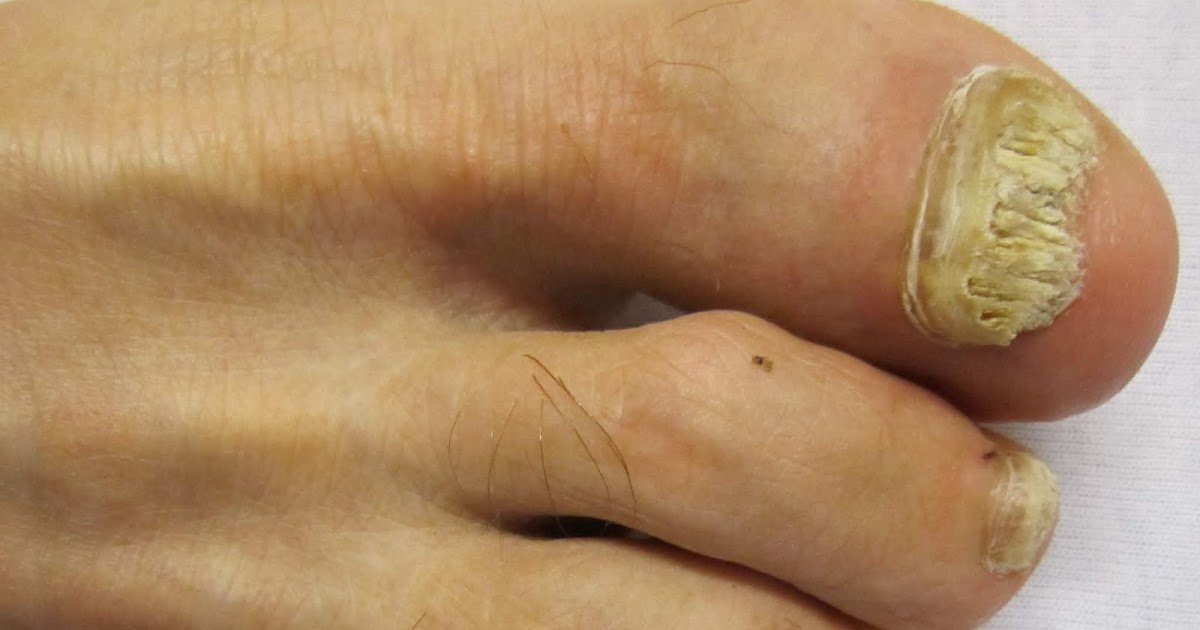 How To Treat Nail Fungus At Home