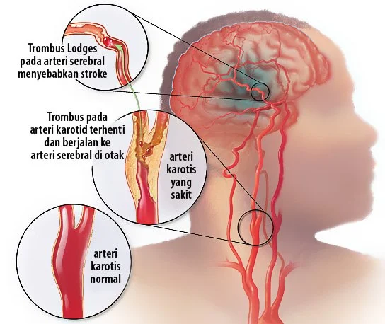 Asuhan Keperawatan (Askep) Cerebro Vascular Accident (CVA) Infark Trombosis