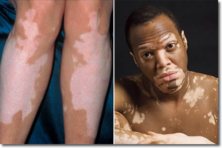 Vitiligo Disease, Vitiligo Skin Disease