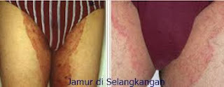 OBAT GATAL EKSIM DI SEKITAR ANUS DAN KEMALUAN WANITA OBAT GATAL EKSIM DI SEKITAR ANUS DAN KEMALUAN WANITA