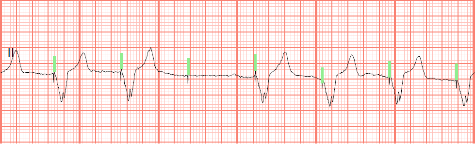 ventricular paced failure to capture ventricular paced failure to capture