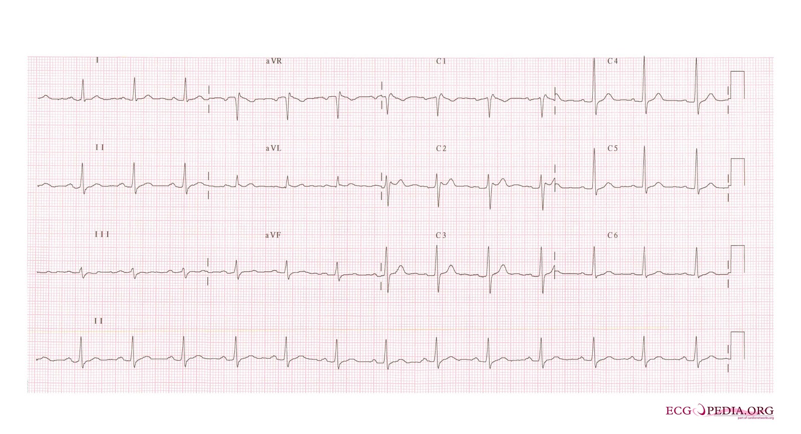 ECG Class Keeping ECGs Simple Brugada Syndrome ecg-class-keeping-ecgs-simple-brugada-syndrome