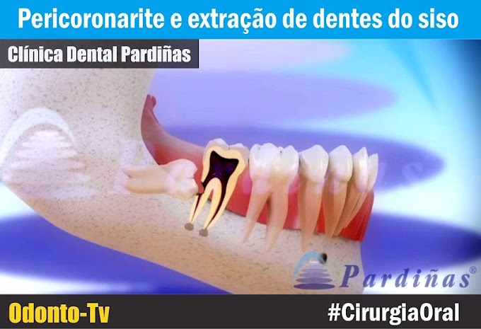 CIRURGIA ORAL: Pericoronarite e extração de dentes do siso