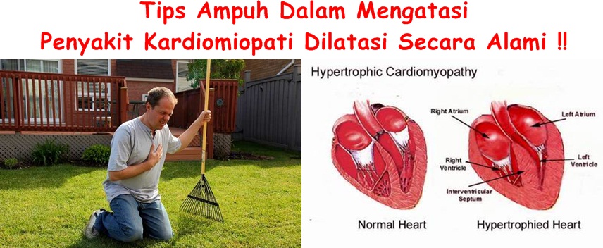 Obat Tradisional Kardiomiopati Dilatasi