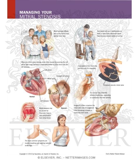 mitral stenosis