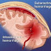 Εγκεφαλική αιμορραγία από Ανεύρυσμα– «Κεραυνός εν αιθρία»