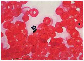 A grapelike cluster of blue-stained S. aureus bacteria and red blood cells, as seen by light microscopy. (From Marler LM, Siders JA, Allen SD. Direct Smear Atlas. Philadelphia, PA: Lippincott Williams & Wilkins; 2001.) A grapelike cluster of blue-stained S. aureus bacteria and red blood cells, as seen by light microscopy. (From Marler LM, Siders JA, Allen SD. Direct Smear Atlas. Philadelphia, PA: Lippincott Williams & Wilkins; 2001.)