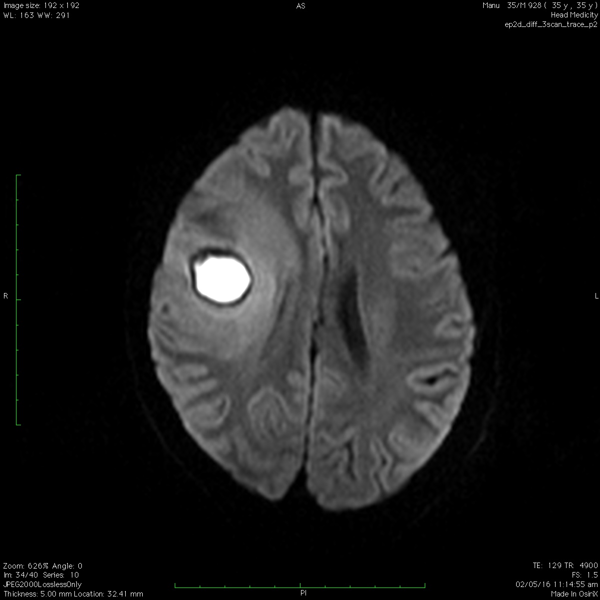 Ultimate Radiology Frontal lobe abscess follow up MRI