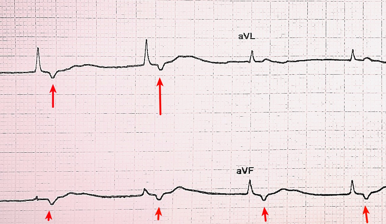 ECG Challenge 3 Inverted waves
