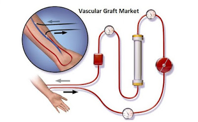 Vascular Graft Market