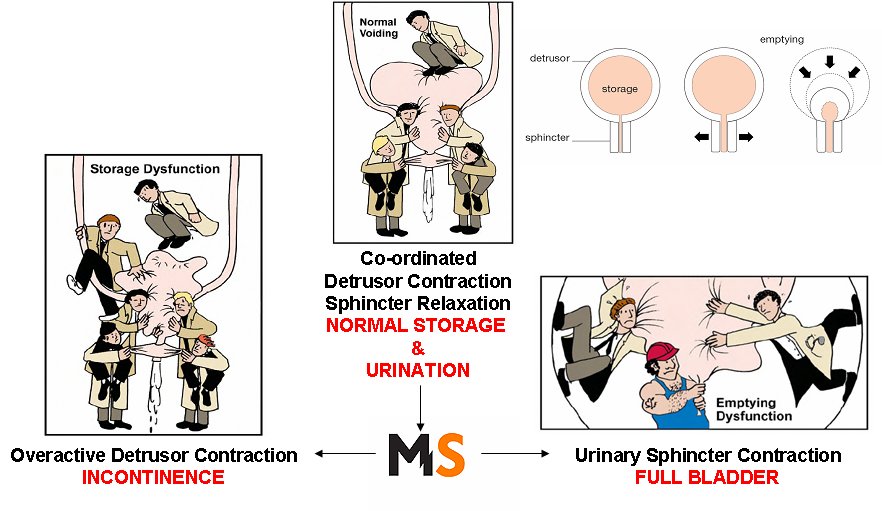 Multiple Sclerosis Research Finding Bladder problems