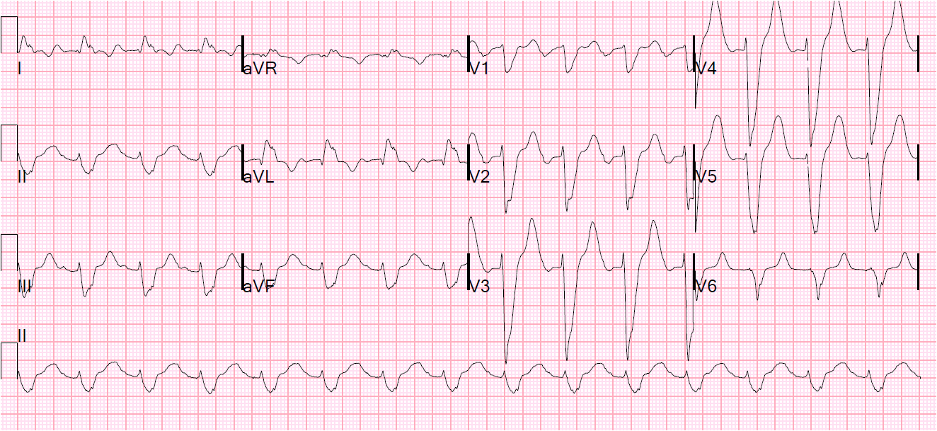 Hyperkalemia Hyperpotassemia Hyperkalemia hyperpotassemia