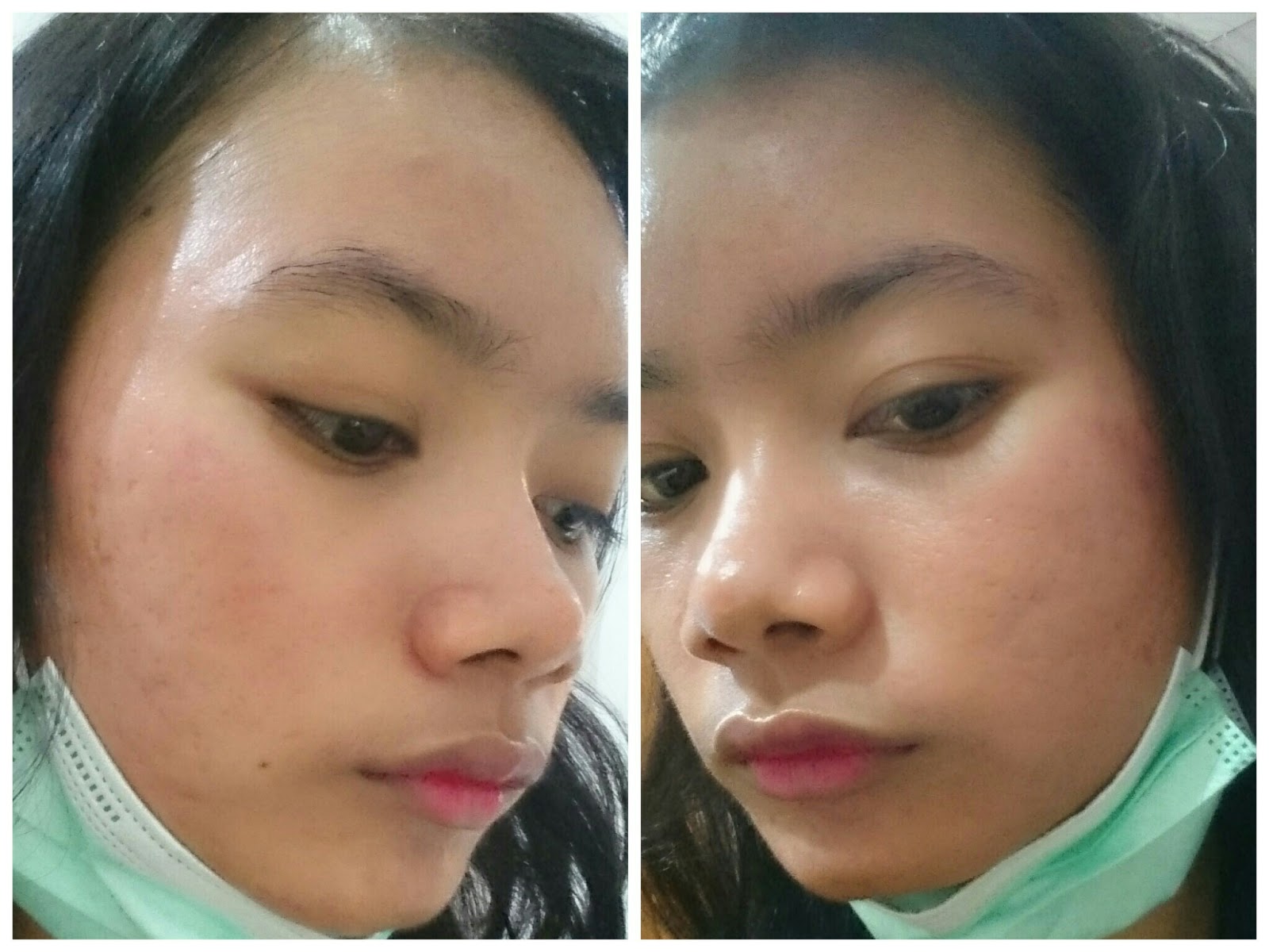 Pengalaman Acne Peel Chemical Peeling Di Natasha Skincare