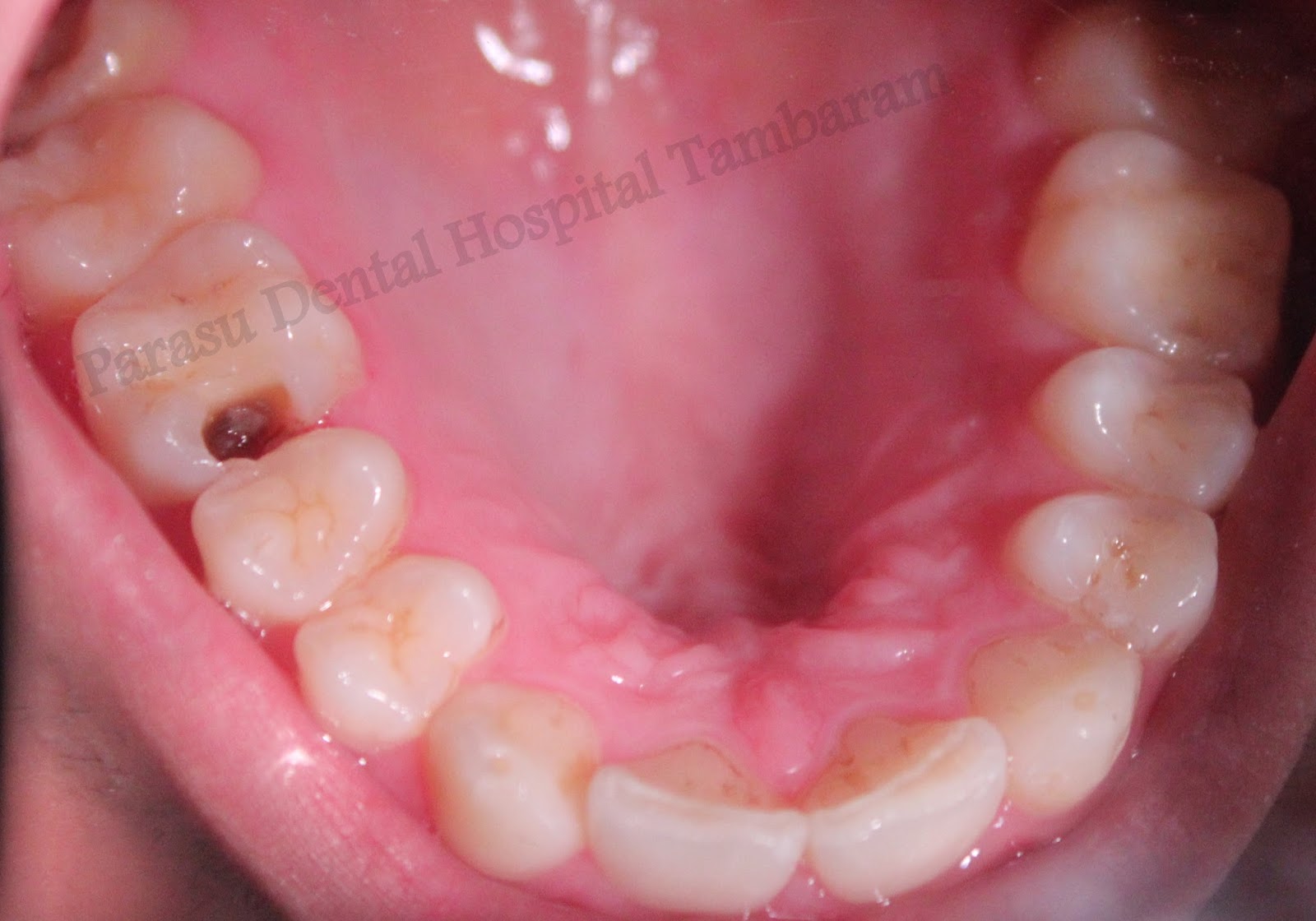 Dental Xray center in medavakkam Best tooth filling treatment in chennai