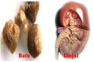 Foto Tanda tanda batu ginjal