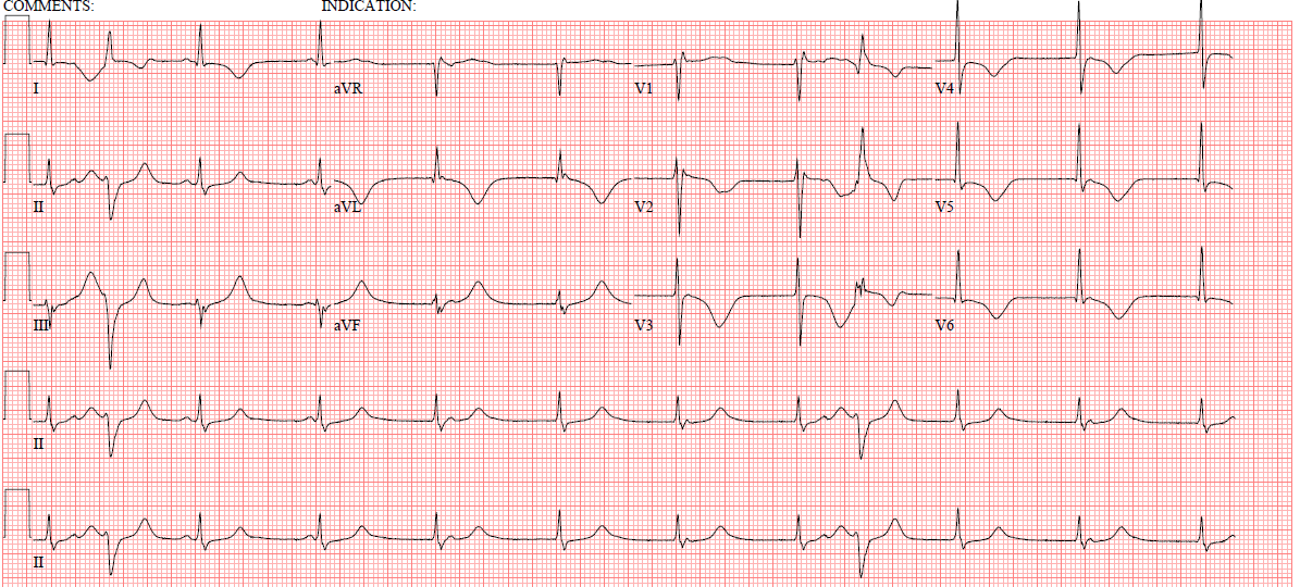 Dr. Smith's ECG Blog: You MUST recognize this pattern, even if it is ...
