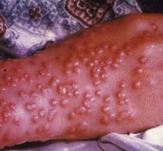 smallpox rash image
