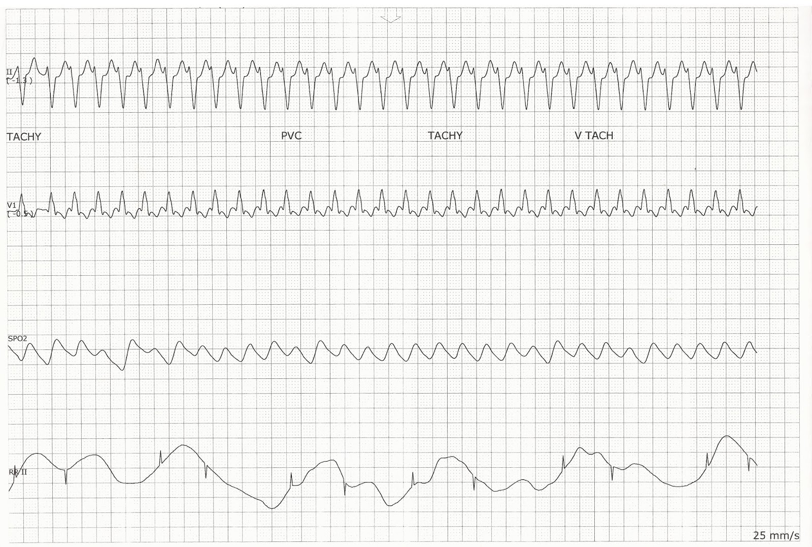 Float Nurse Wide Complex Tachycardia Changing to VT.
